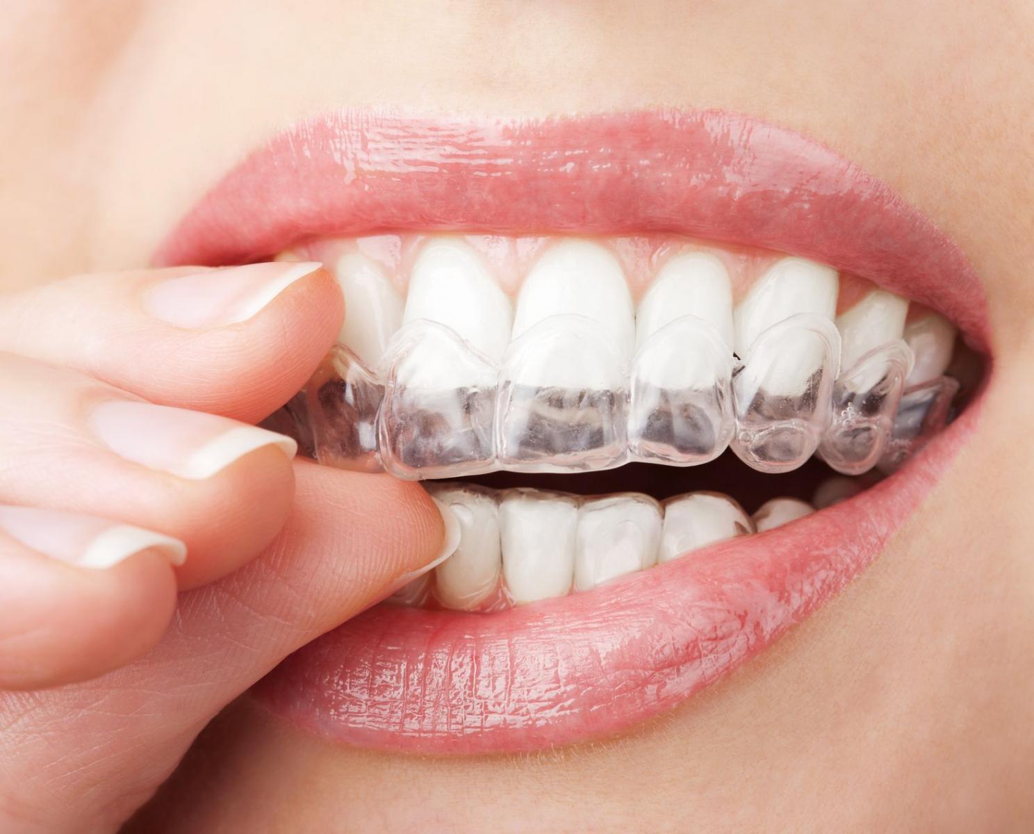 Niềng răng Invisalign